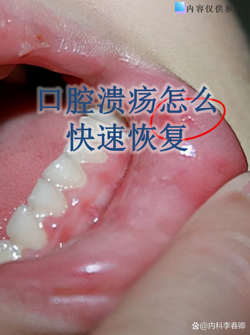 口腔含白酒能治溃疡吗?