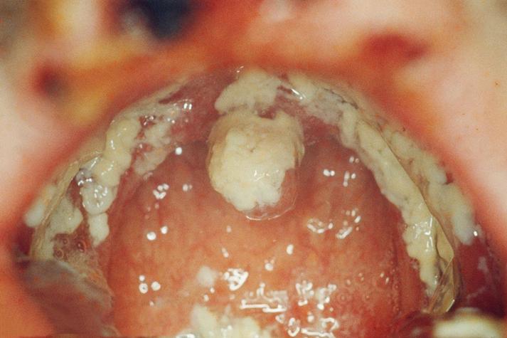 口腔白色念珠菌有哪些典型表现?