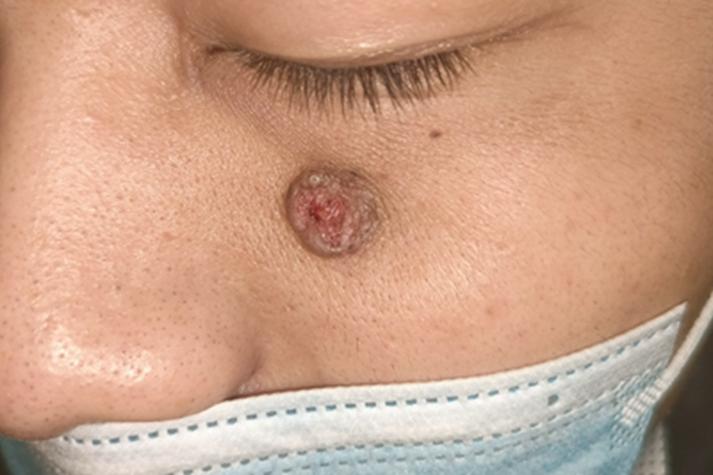 皮肤癌早期症状有哪些?