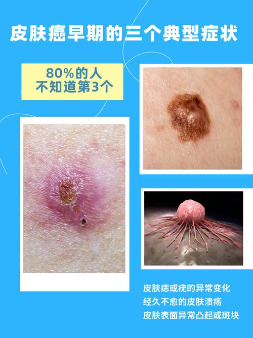 皮肤癌早期症状有哪些?