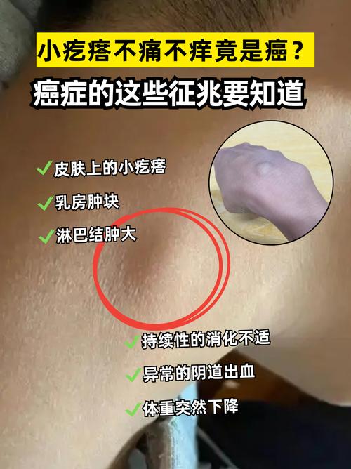 皮肤癌早期症状有哪些?