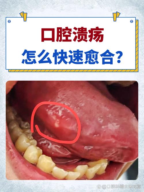 口腔溃疡吃辣的会痛加重吗?