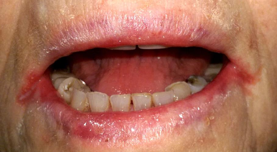 口腔白色念珠菌症状图