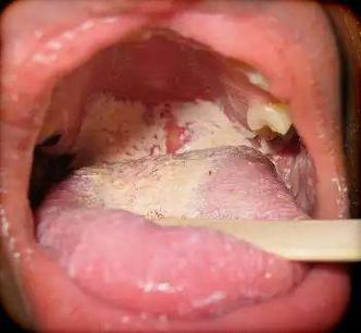 口腔白色念珠菌症状图