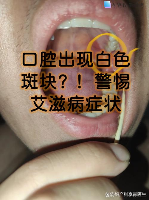 口腔白色念珠菌症状图