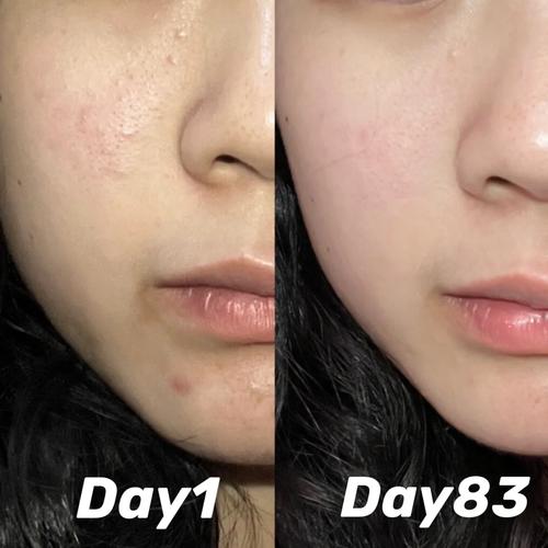 不熬夜多久皮肤会变好