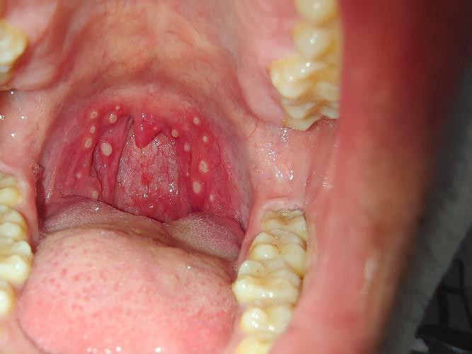 口腔溃疡长到喉咙里了