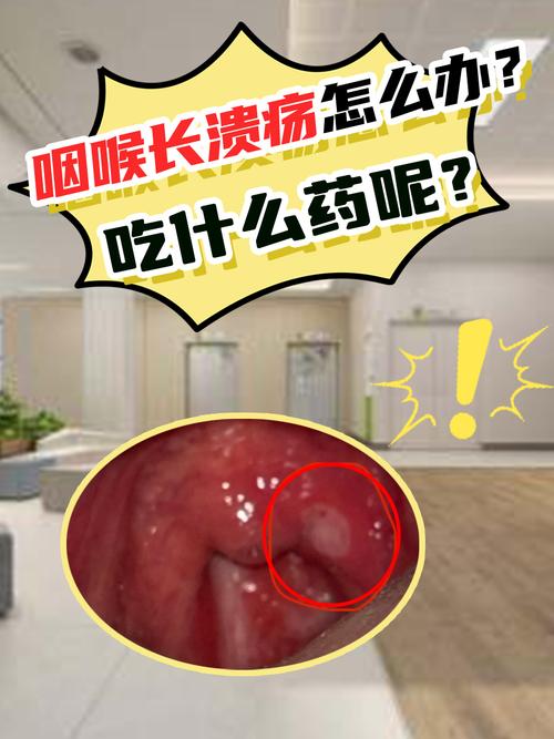 口腔溃疡长到喉咙里了