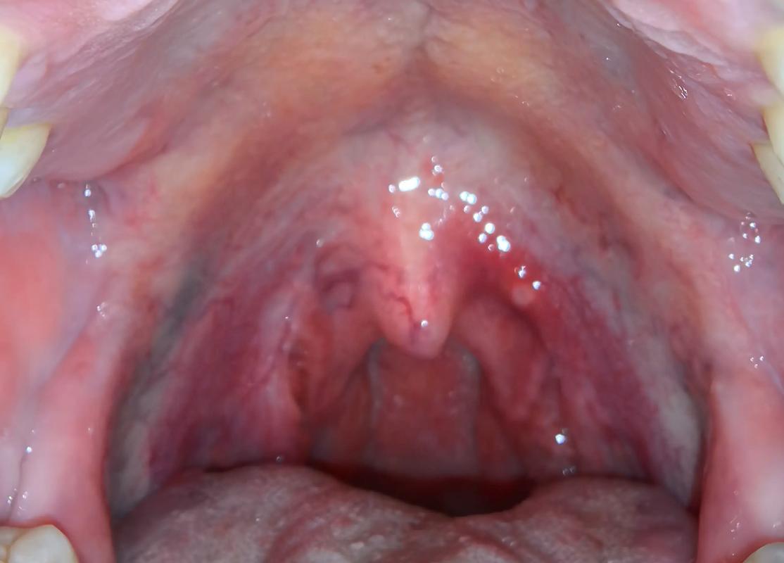 口腔溃疡长到喉咙里了