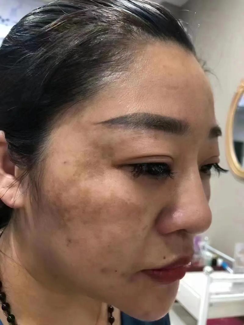 皮肤差问题,男女谁更困扰?