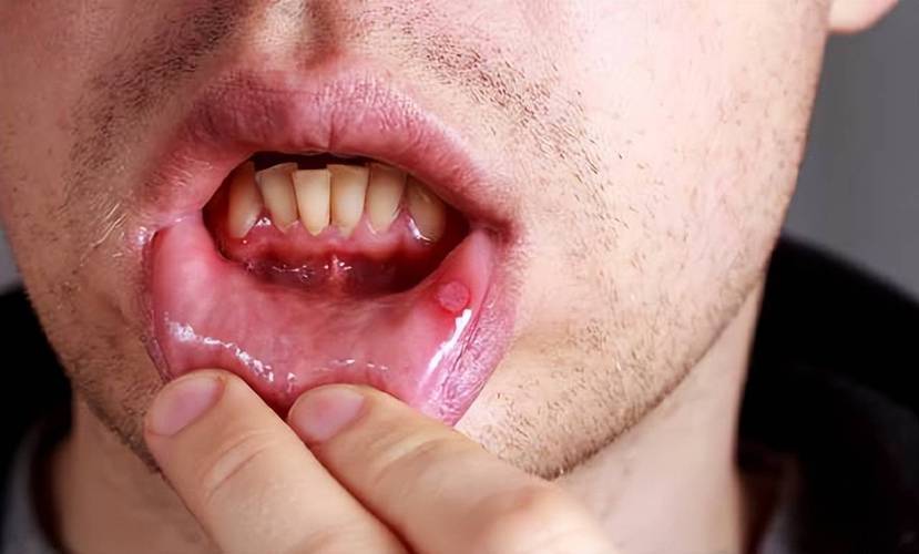 口腔肿瘤是什么样子的