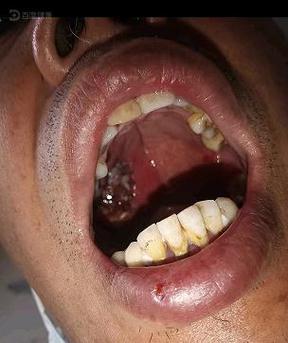 口腔肿瘤是什么样子的