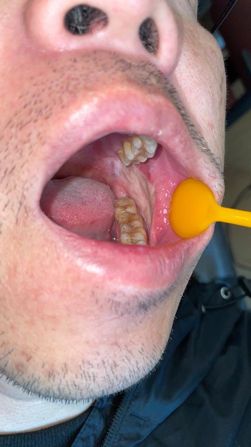 口腔肿瘤是什么样子的