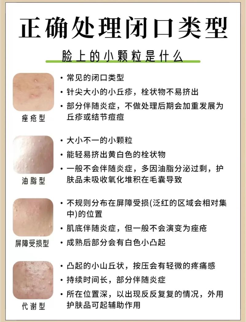 皮肤闭口是怎么形成的?