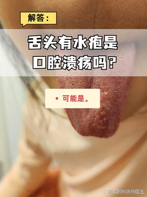 口腔被热水烫了怎么办