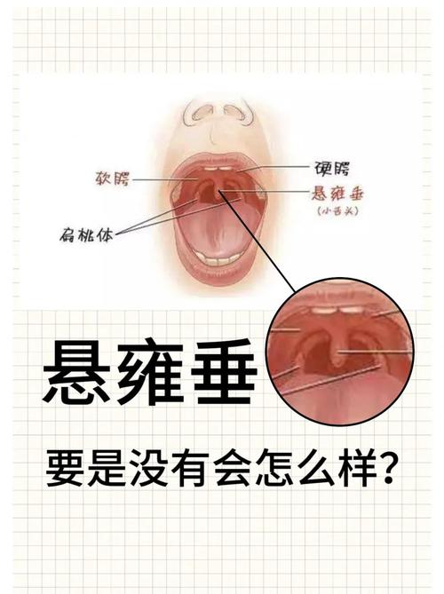 口腔内的小垂是什么?