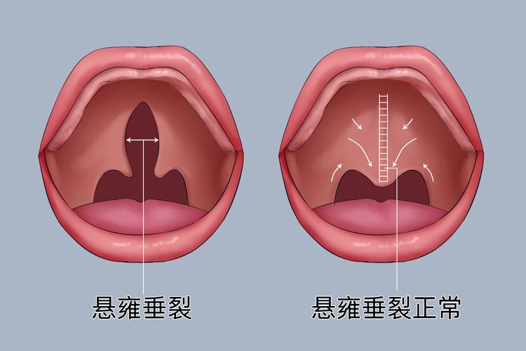口腔内的小垂是什么?