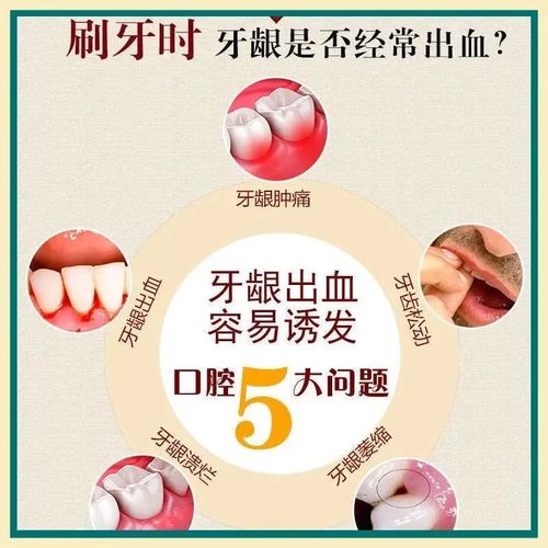 牙龈口腔溃疡,该用啥药好得快?