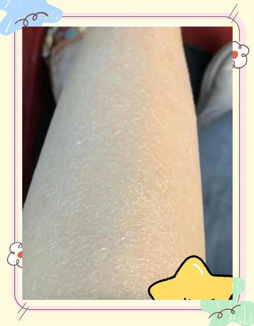 冬天全身皮肤干燥脱皮怎么办?