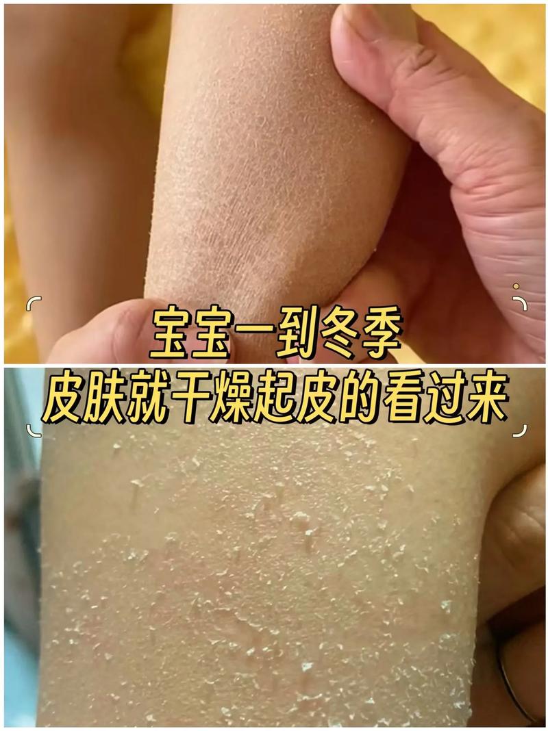 冬天全身皮肤干燥脱皮怎么办?
