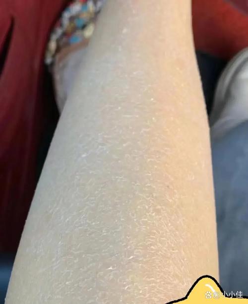 冬天全身皮肤干燥脱皮怎么办?