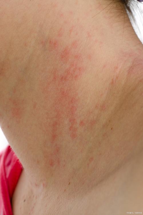 皮肤过敏各种症状图片