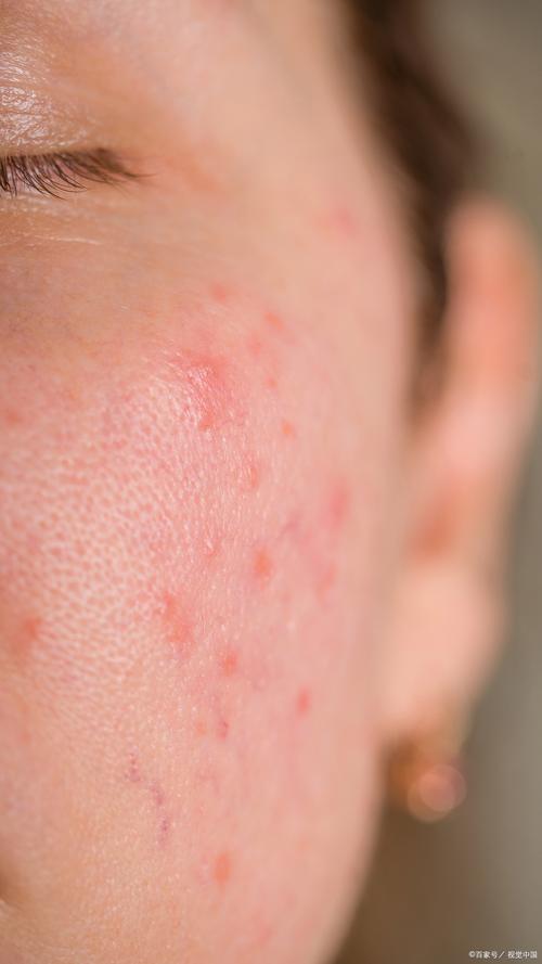 皮肤过敏各种症状图片