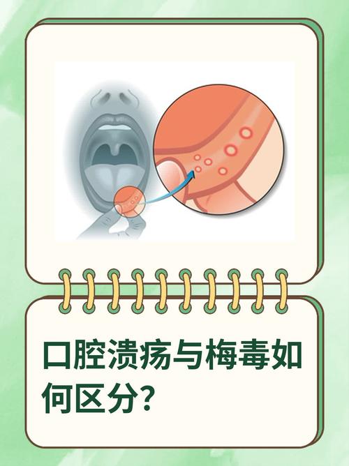 疱疹和口腔溃疡是一回事吗?