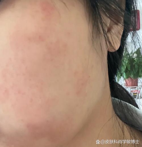 皮肤补水后痒发红,是过敏还是补错了?