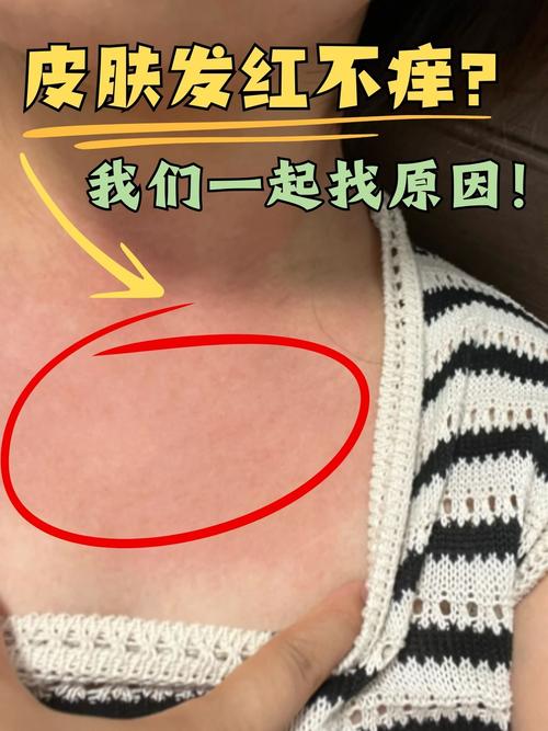 皮肤补水后痒发红,是过敏还是补错了?