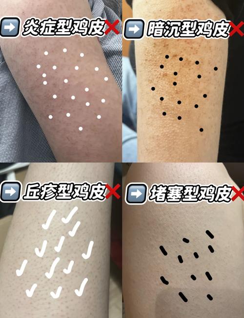 鸡皮肤怎么去除?30字小妙招有哪些?