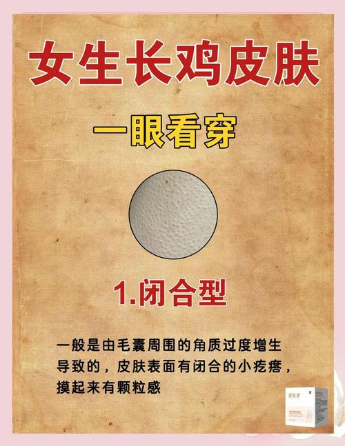 鸡皮肤怎么去除?30字小妙招有哪些?