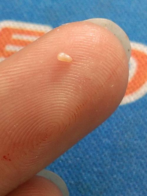 皮肤挤出白色米粒硬物是啥?咋回事?