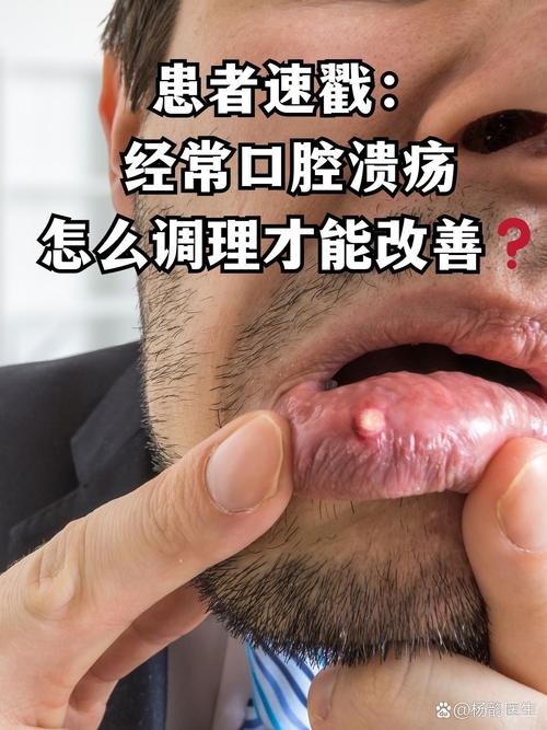 胃炎会引发口腔溃疡吗?