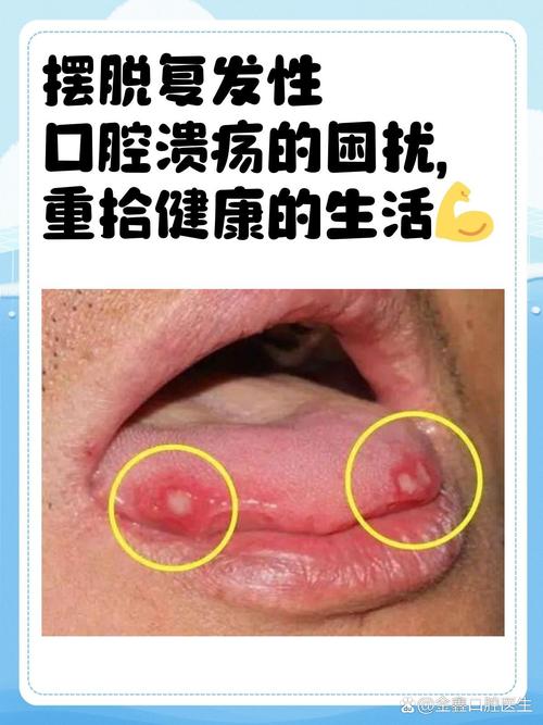 胃炎会引发口腔溃疡吗?