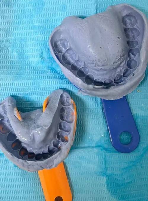 护士口腔取模调模视频如何操作?