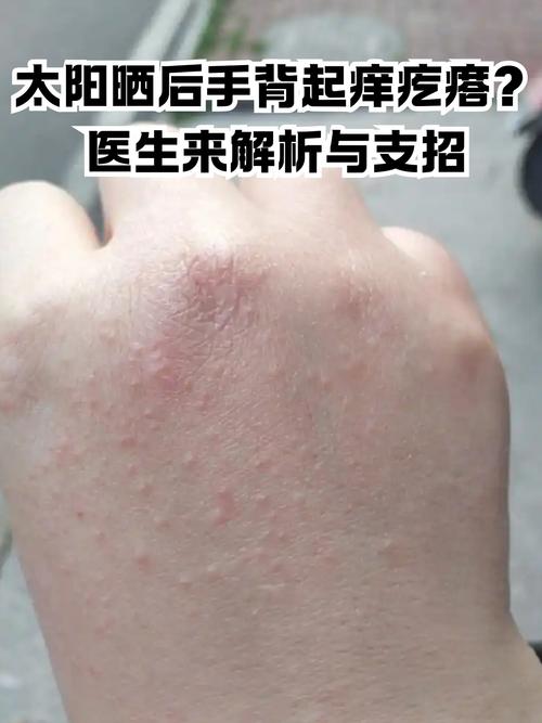 皮肤暴晒后又红又痛痒