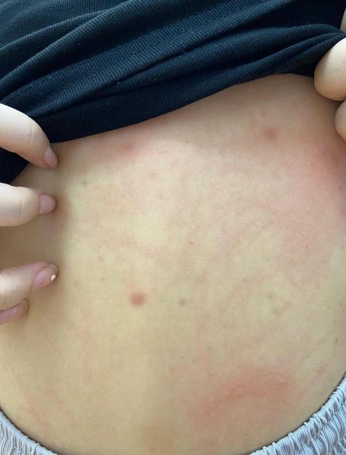 皮肤暴晒后又红又痛痒