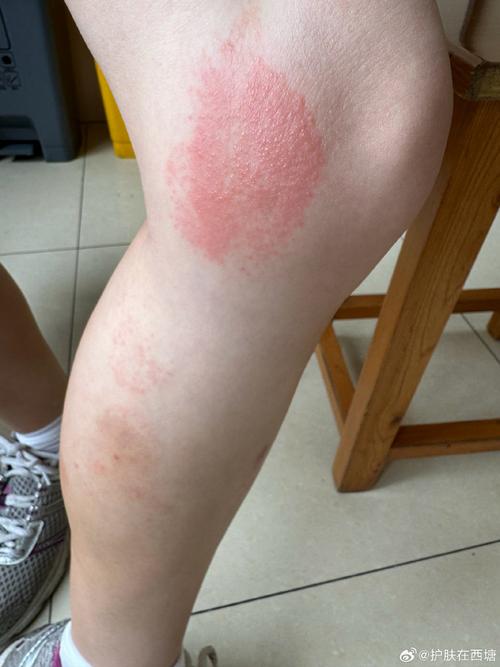 皮肤暴晒后又红又痛痒