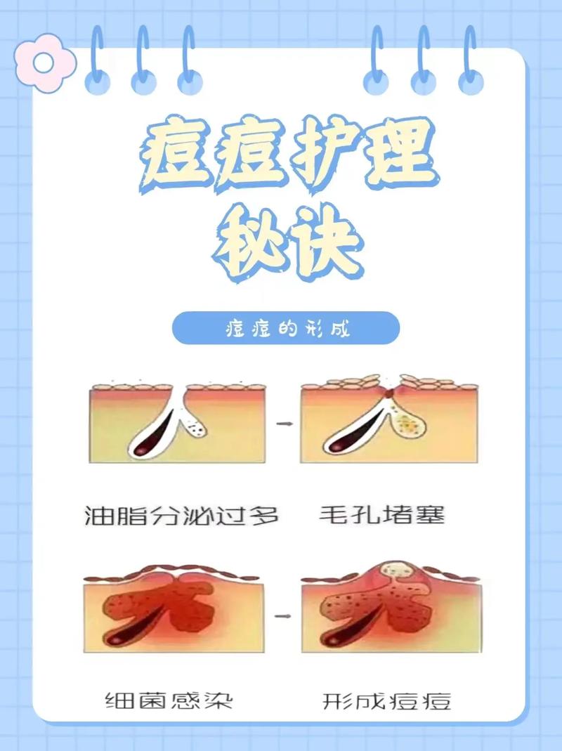 如何有效预防痘痘生成?