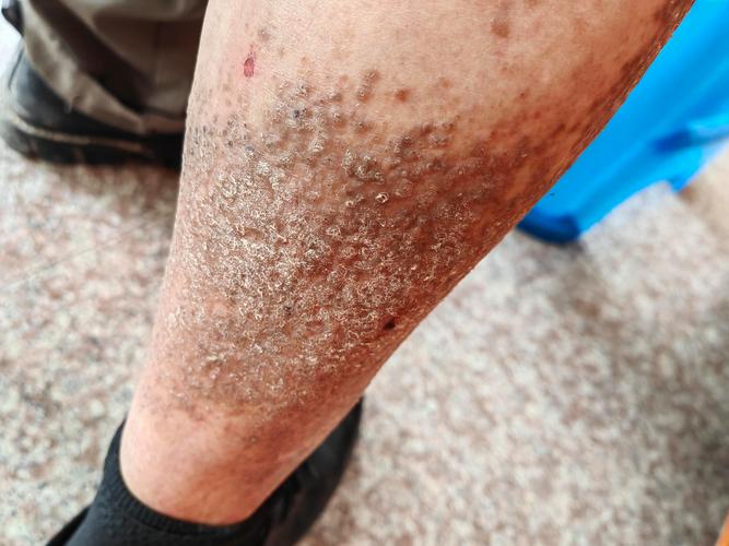 皮肤变褐粗糙痒,是何原因所致?