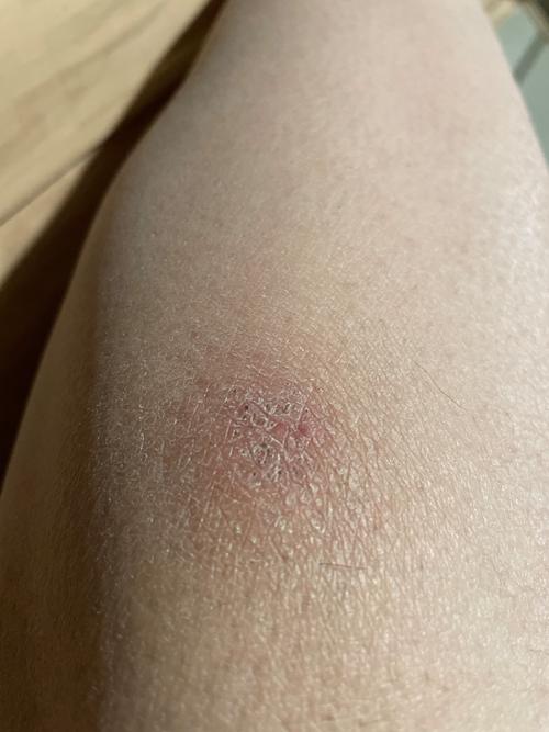 皮肤变褐粗糙痒,是何原因所致?