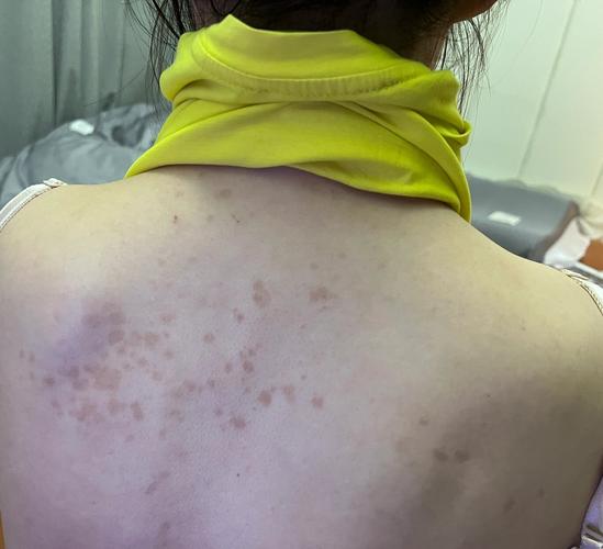 皮肤变褐粗糙痒,是何原因所致?