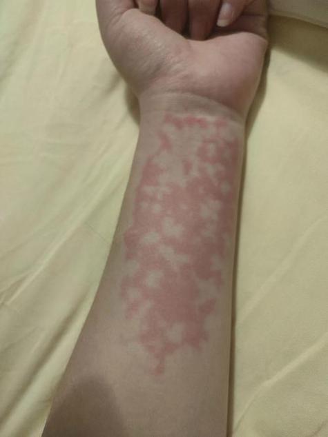 婴儿正常花纹皮肤图片