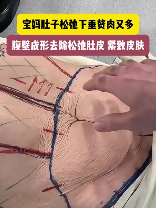 腹部松弛皮肤如何有效收紧?