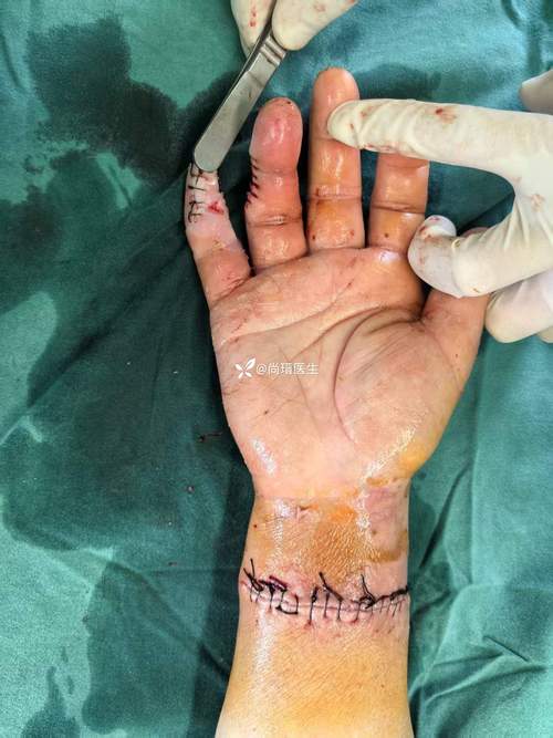 强碱腐蚀皮肤如何紧急处理?