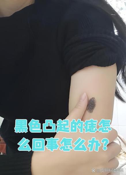 皮肤黑色硬结凸起图片