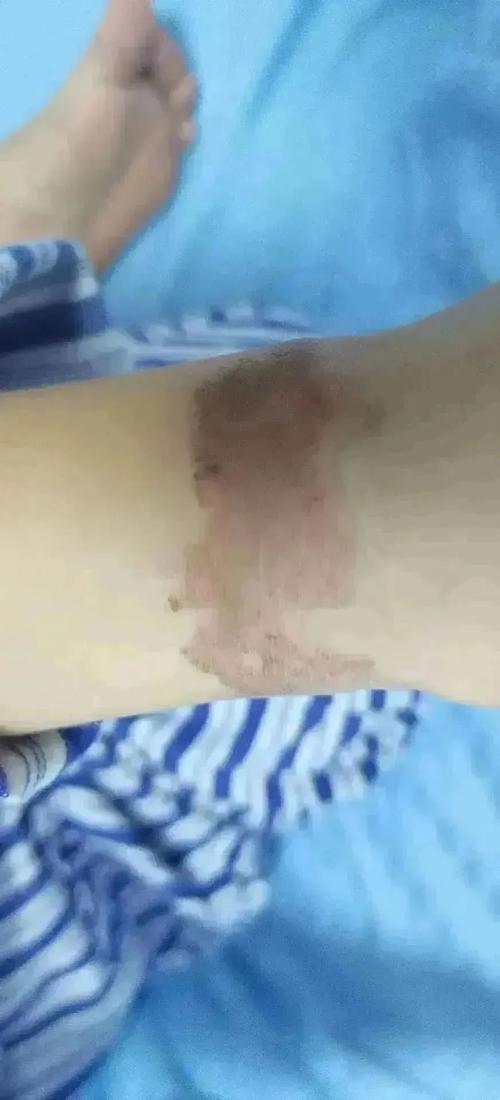 硫酸弄到皮肤上会怎样