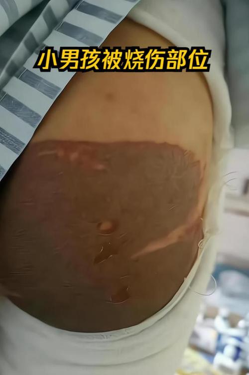 硫酸弄到皮肤上会怎样