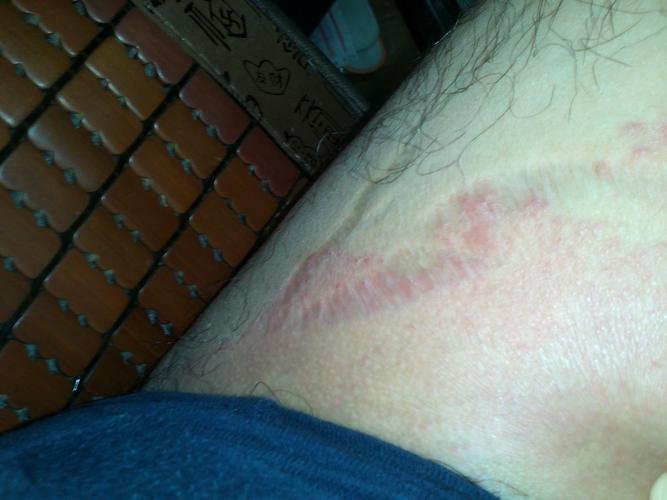 大腿内侧皮肤褶皱图片是正常现象吗?